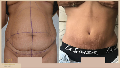 tummy-patient1